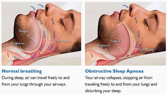 Sleep Apnea Book An Appointment Avenue Dental