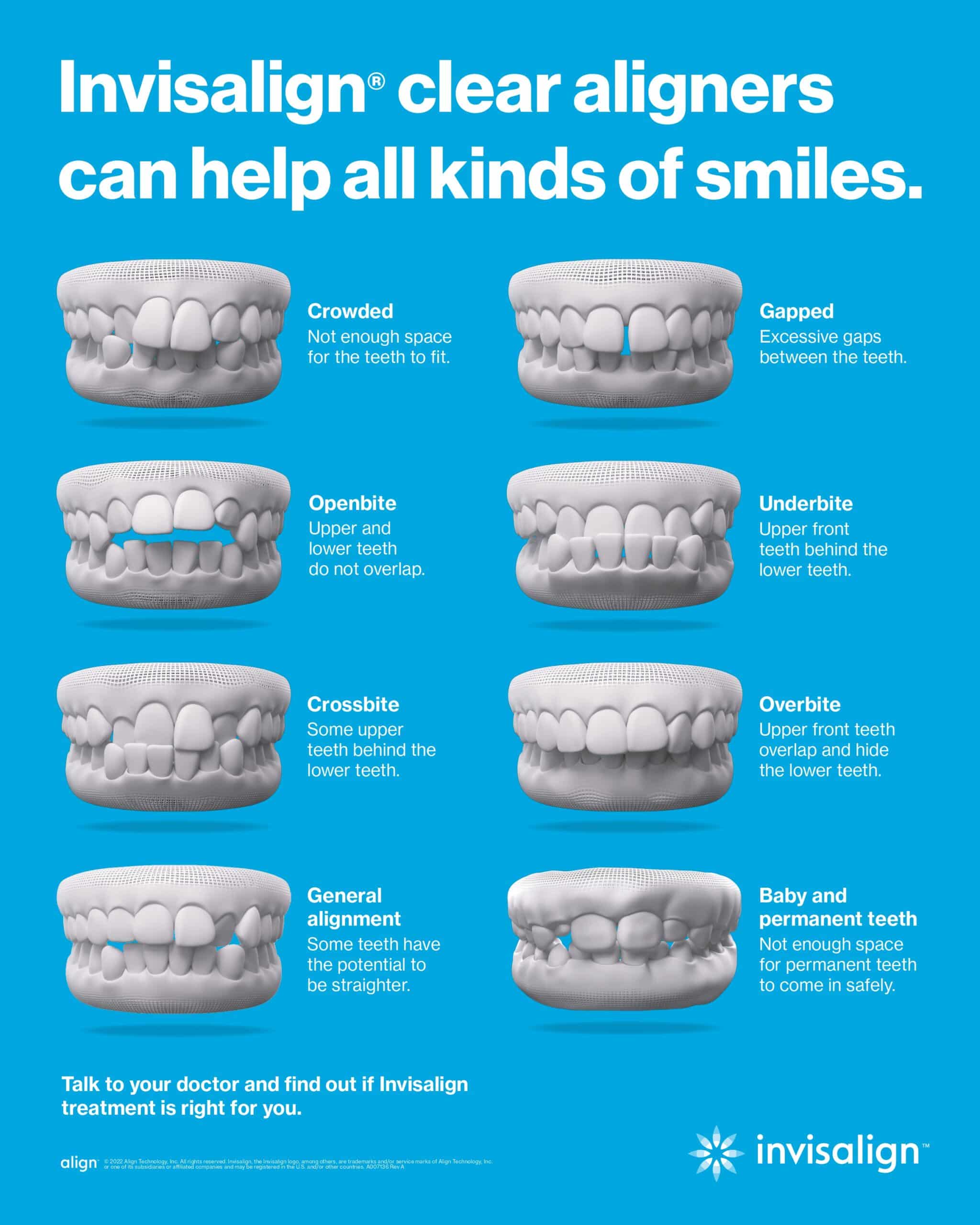 Clear Aligner Orthodontics In Ypsilanti MI Avenue Dental